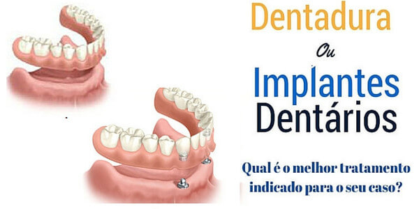 implante dentário ou dentadura em blumenau
