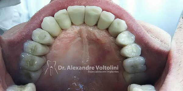 coroa sobre implante dentário 2