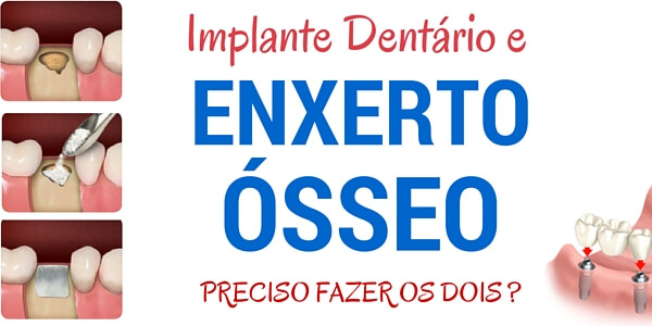 implante dentario e enxerto ósseo dentario (1)