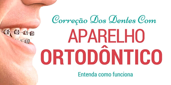 aparelhos ortodonticos em blumenau (1)