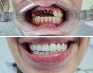 implante dentário em Blumenau com clareamento