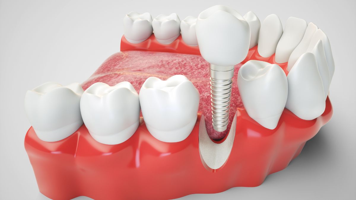 : Comparação de Prótese e Implante Dentário: Vantagens e Desvantagens.