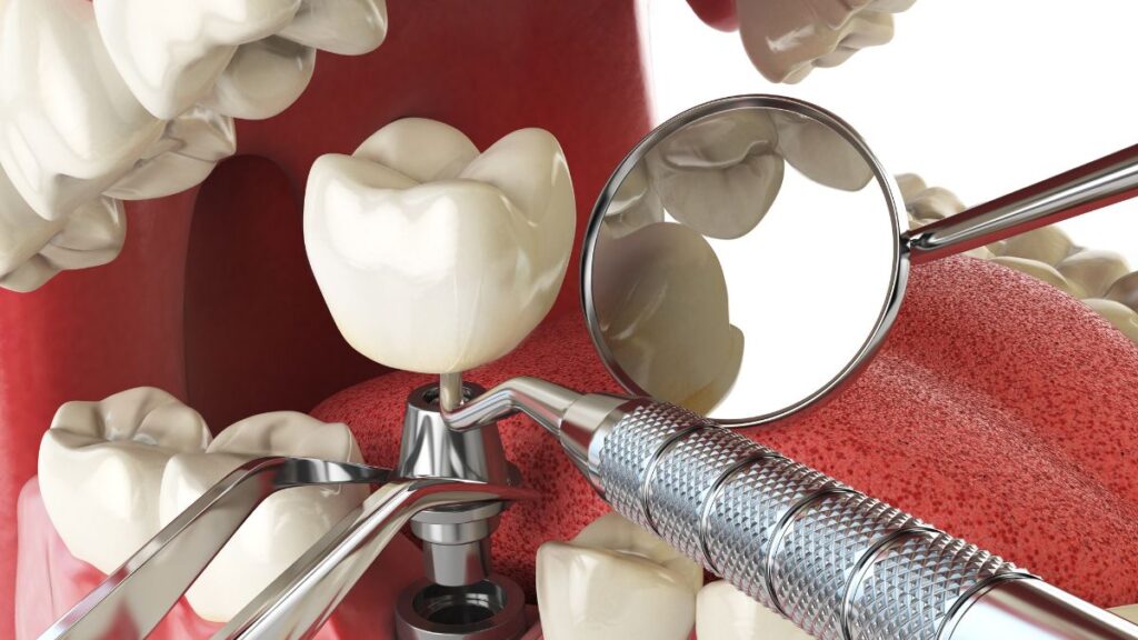 prenda a prevenir a formação de biofilme em implantes dentários