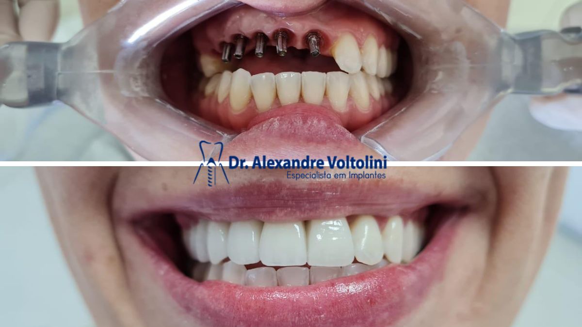 implante dentário unitário e clareamento dental