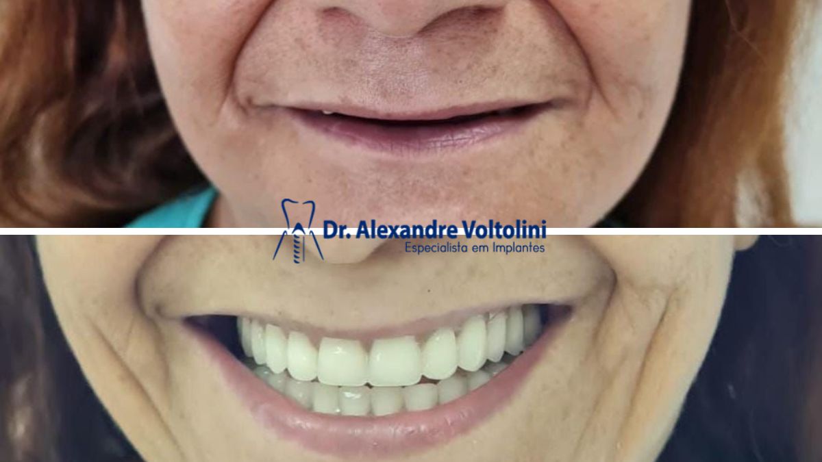 Benefícios dos Implantes Dentários para Idosos antes e depois dr alexandre voltolini