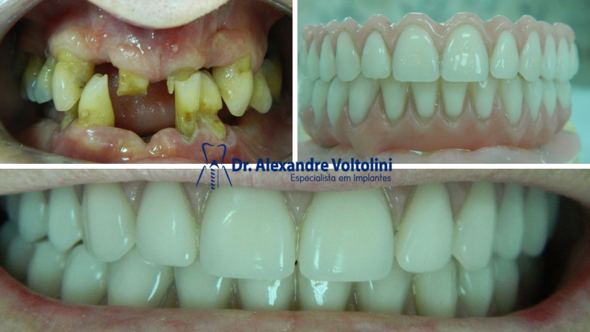 Prótese Protocolo fixo e implantes dentários trazem benefícios para a estética e função bucal."