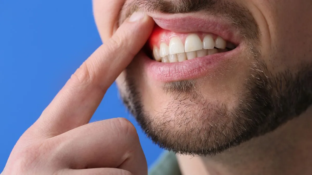 Aprenda sobre os tipos de tratamento para doenças gengivais e como preservar a saúde dos seus implantes dentários.
