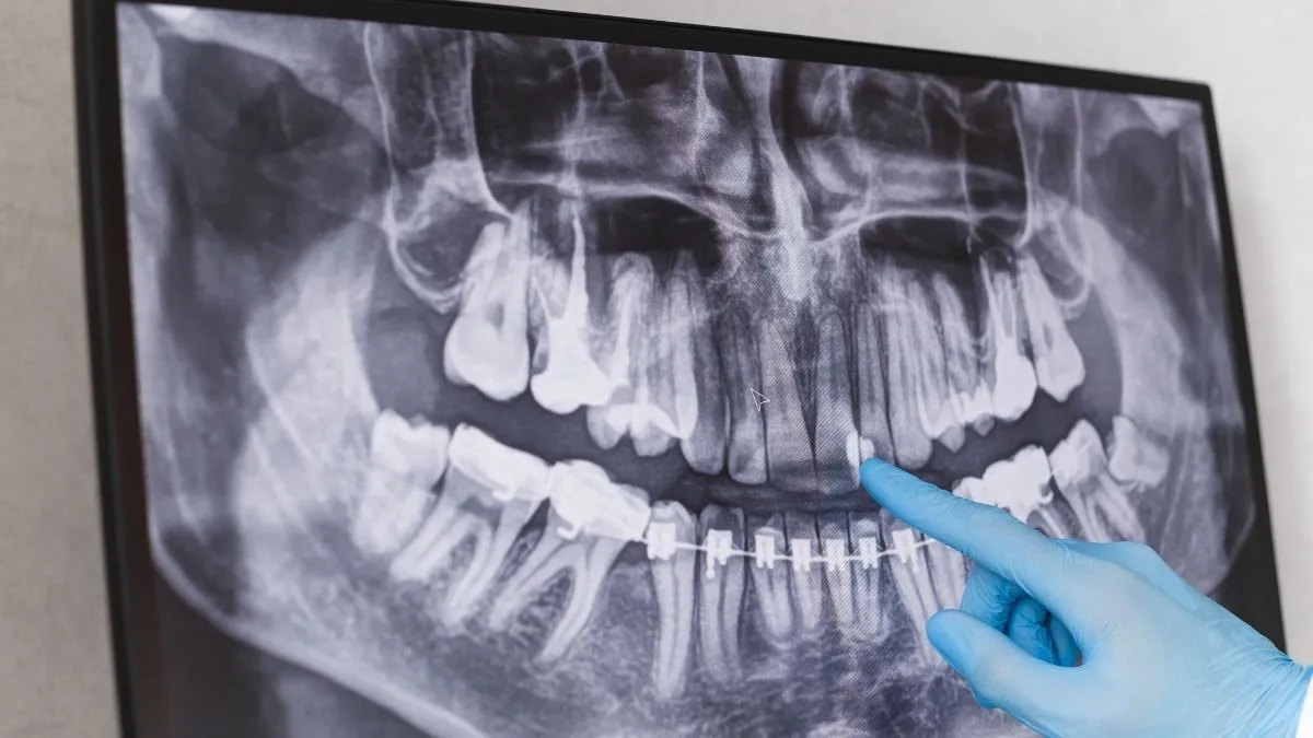 2ª Etapa do Implante Dentário: Planejamento Personalizado