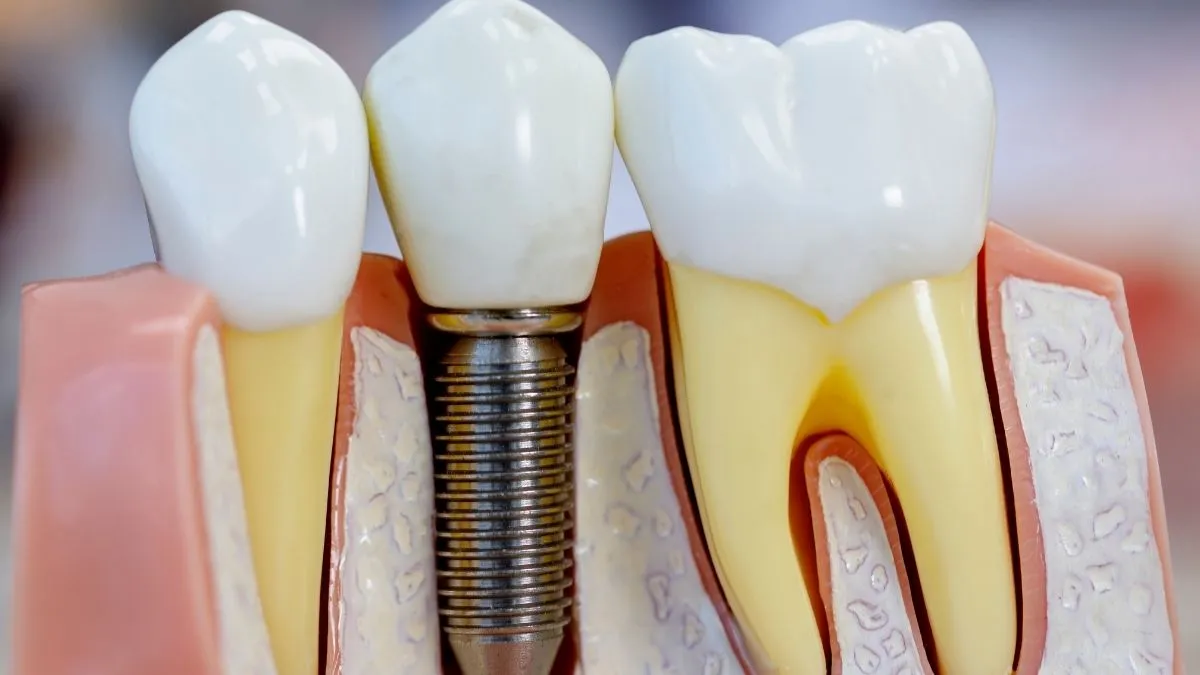 4ª Etapa do Implante Dentário: Cicatrização Óssea e Osseointegração @dralexandre voltolini