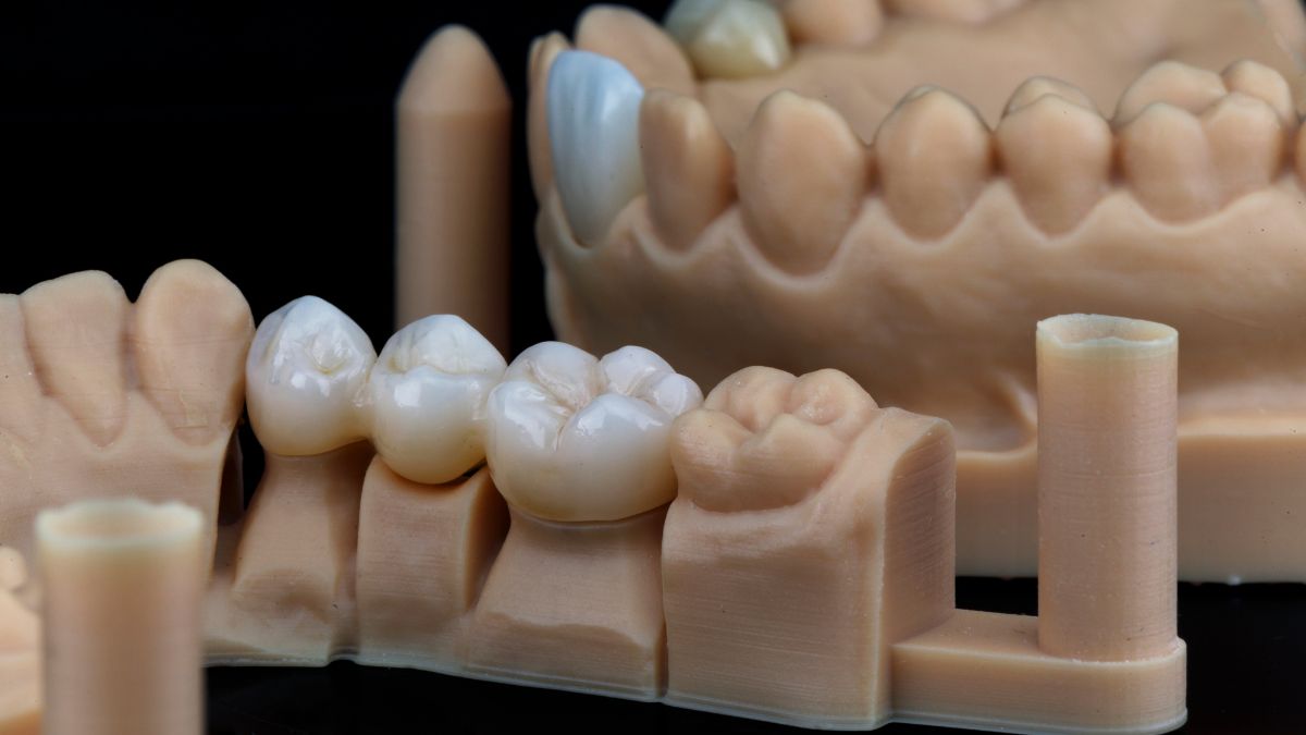 6a-Etapa-do-Implante-Dentario-Confeccao-da-Coroa-ou-Protese-Personalizada@dralexandre-voltolin