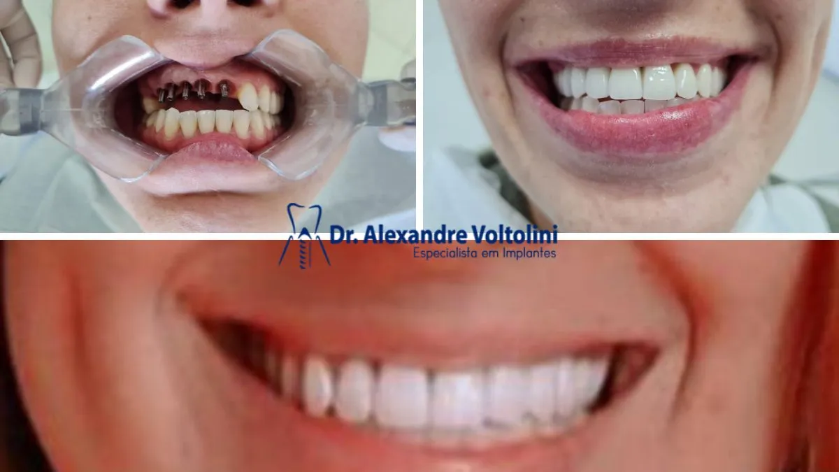 3 etapa do implante dentário unitário em Blumenau com clareamento nos dentes naturais
