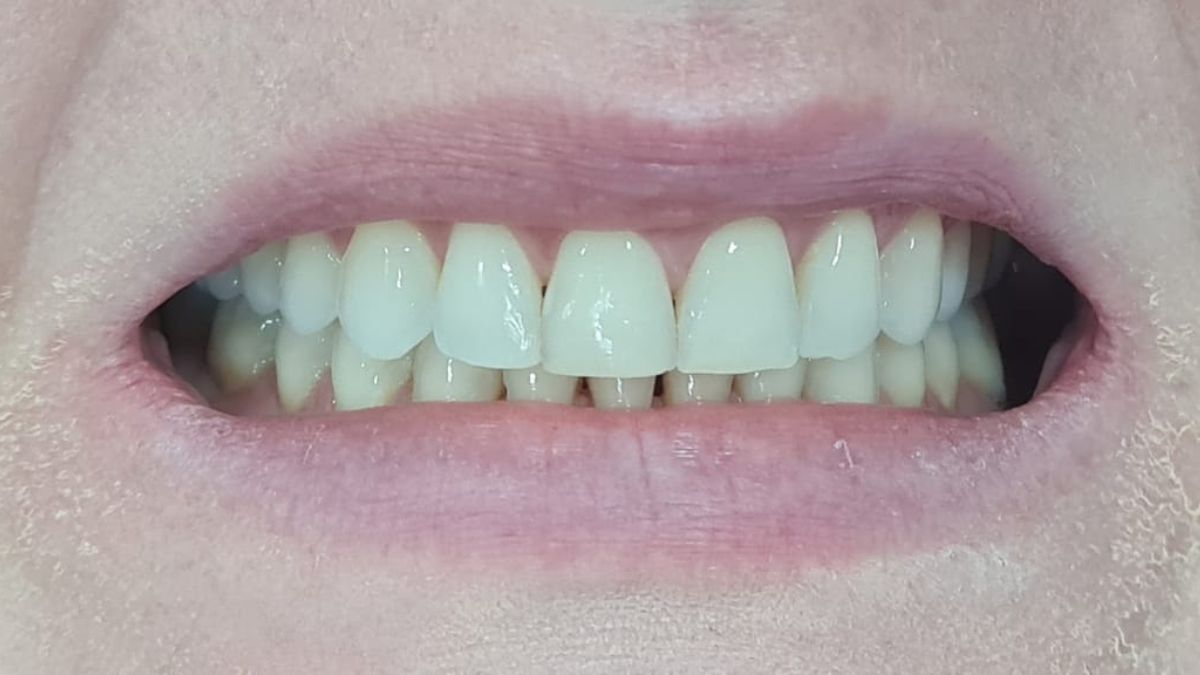 facetas em resina em blumenau dr alexandre voltlini