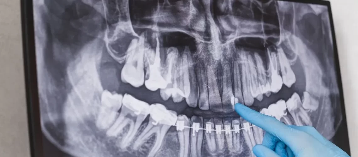 2ª Etapa do Implante Dentário: Planejamento Personalizado