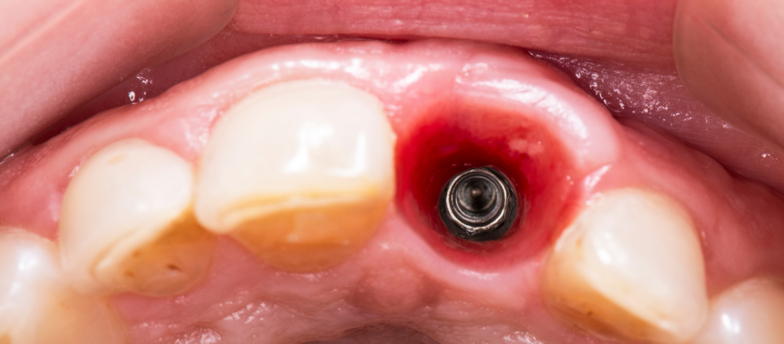 3ª Etapa do Implante Dentário Cirurgia de Implante- dr alexandre voltolini