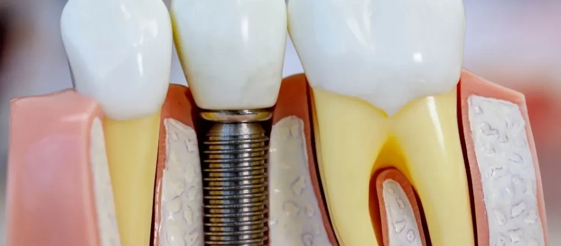 4ª Etapa do Implante Dentário: Cicatrização Óssea e Osseointegração @dralexandre voltolini