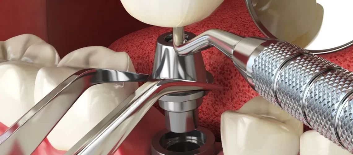 5a-Etapa-do-Implante-Dentario-Colocacao-do-Pino-ou-Conector-dr-alexandre-voltolini.webp