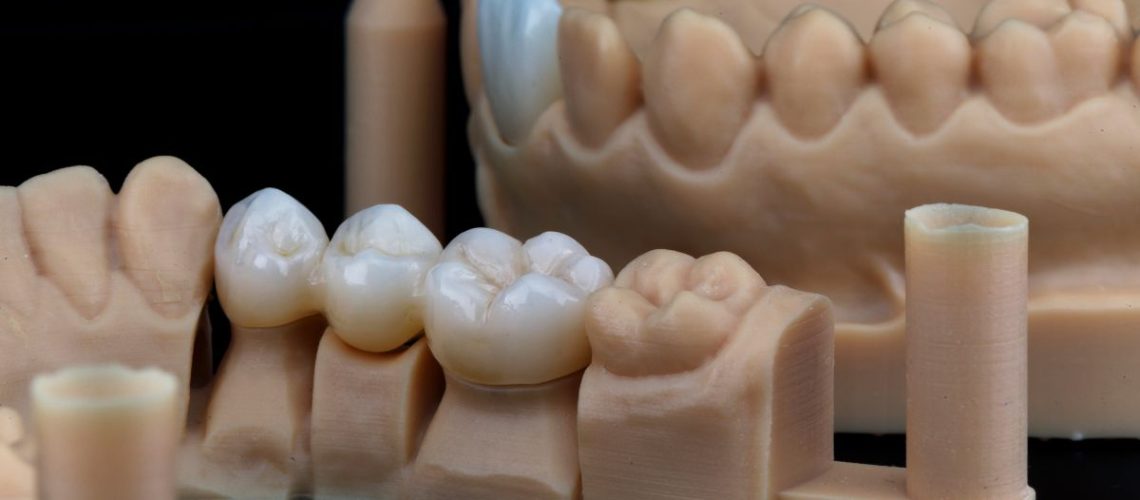 6a-Etapa-do-Implante-Dentario-Confeccao-da-Coroa-ou-Protese-Personalizada@dralexandre-voltolin