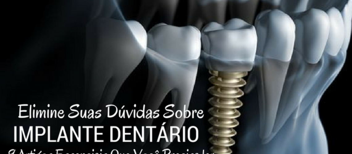 9 artigos sobre implantes dentários em blumenau (1)