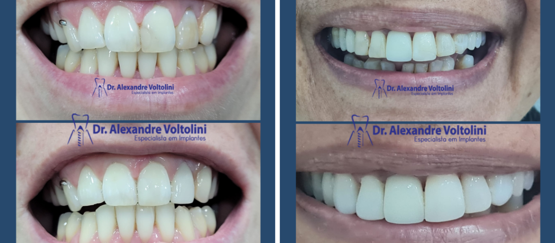 FACETAS EM BLUMENAU DR. ALEXANDREVOLTOLINI (1200 x 675 px)