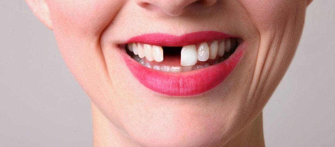 Implante e Dente Provisório: Descubra como manter a aparência e confiança com um dente provisório durante o processo