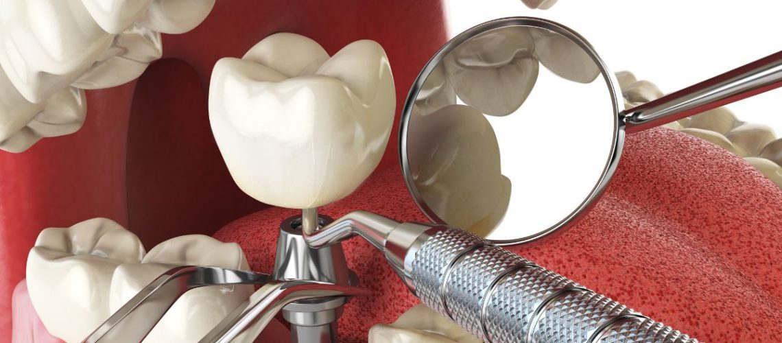 prenda a prevenir a formação de biofilme em implantes dentários