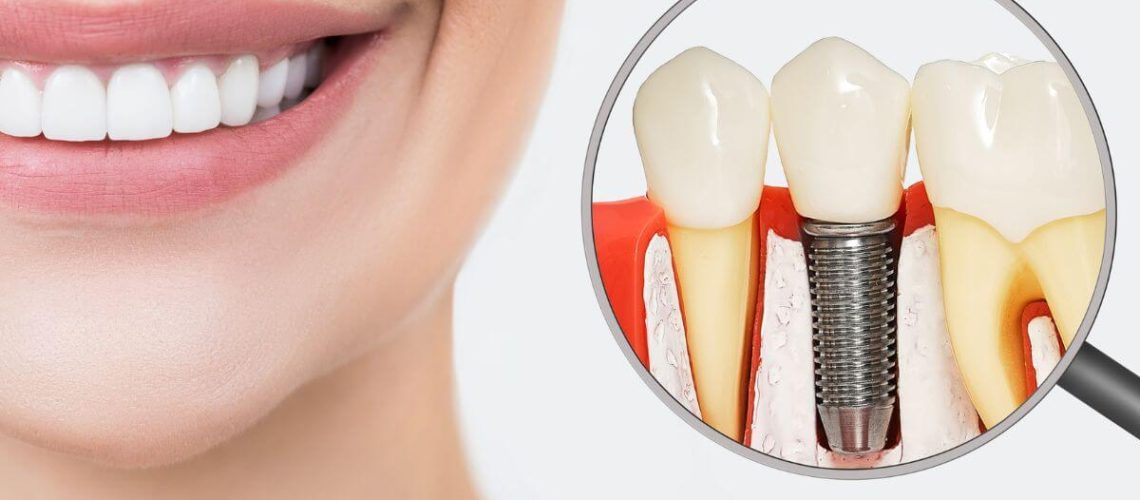 Implantes DentArios com Dr Alexandre Voltolini Da Origem A ExcelEncia”