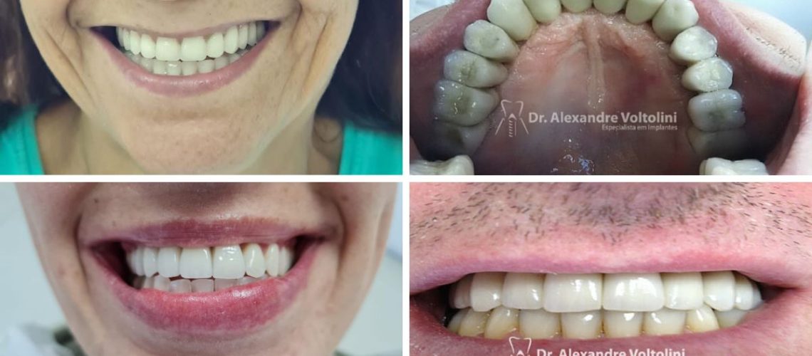 _Implante Dentário em Blumenau antes e depois - dr alexandre voltolini