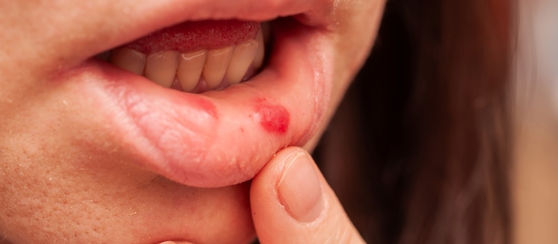aftas e tratamento