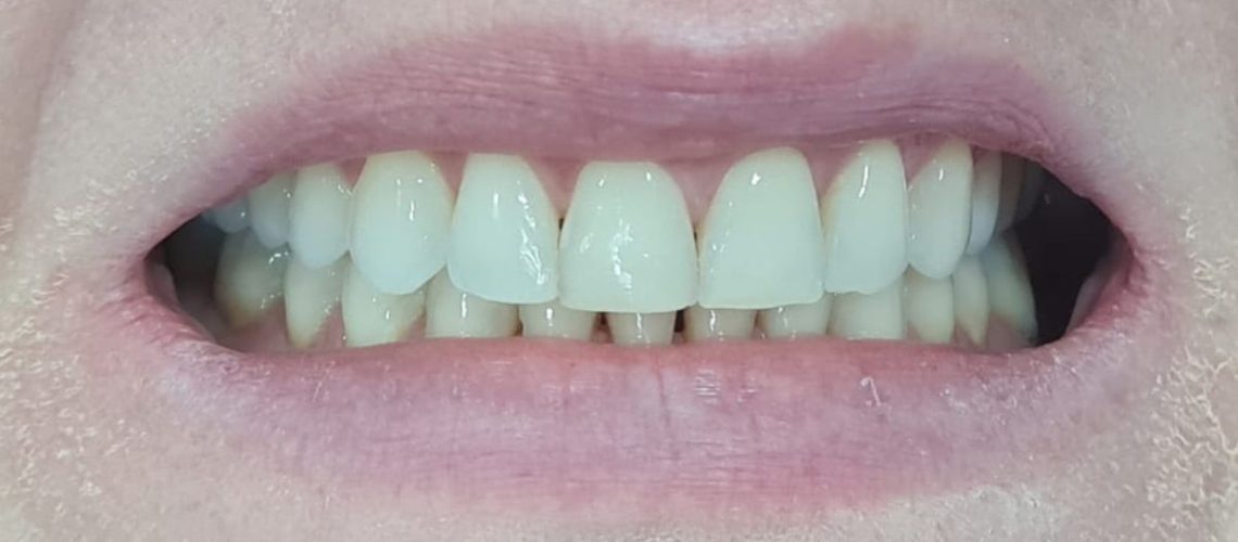 facetas em resina em blumenau dr alexandre voltlini