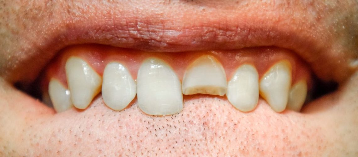 fratura dental DR. ALEXANDREVOLTOLINI (1200 x 675 px)