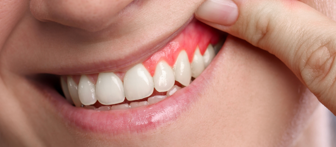 gengiva e implante dentário DR. ALEXANDREVOLTOLINI (1200 x 675 px)