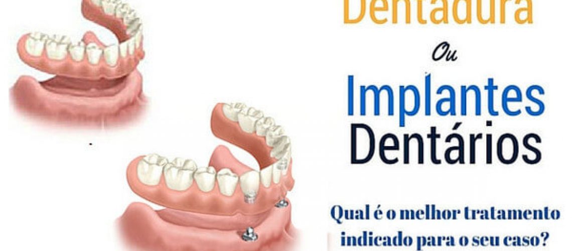 implante dentário ou dentadura em blumenau