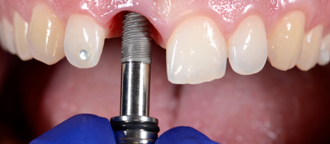 implante dentario em blumenau imagem destacada 1200x675 (1)