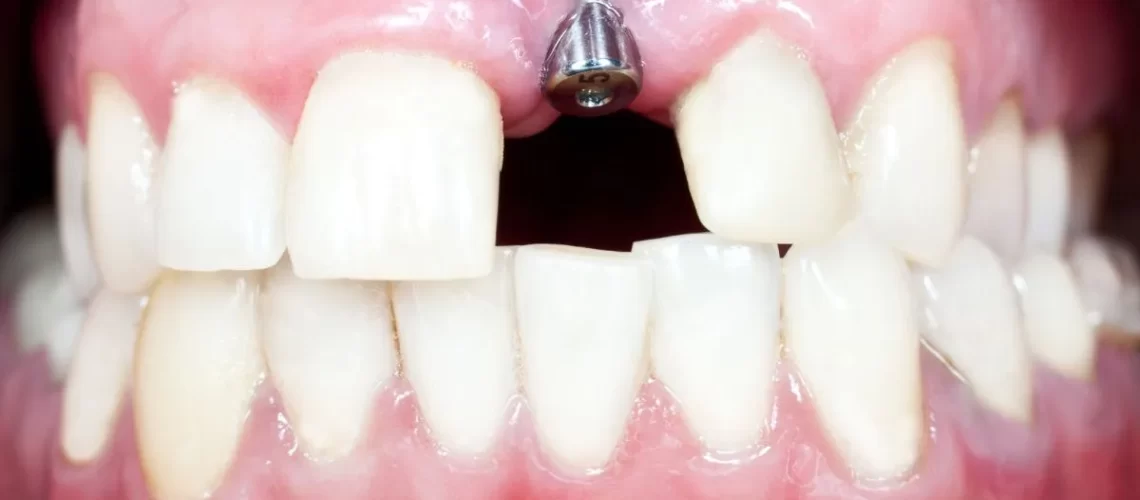 implante-dentário-unitário-_dralexandrevoltolini-