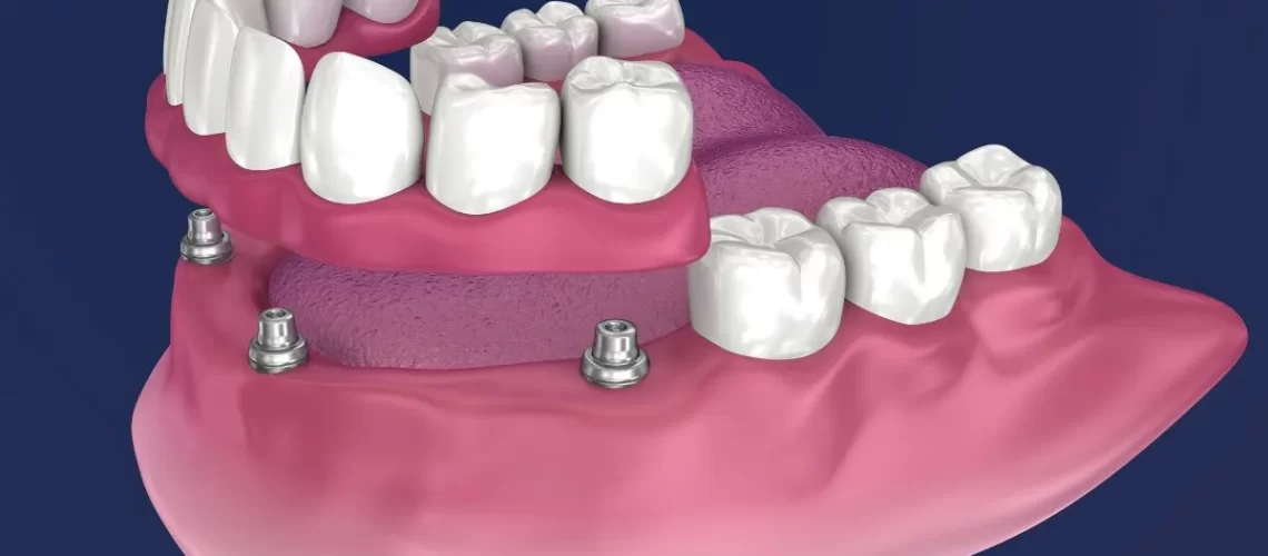 Prótese Overdenture em Implantes Dentários pode proporcionar estabilidade e conforto