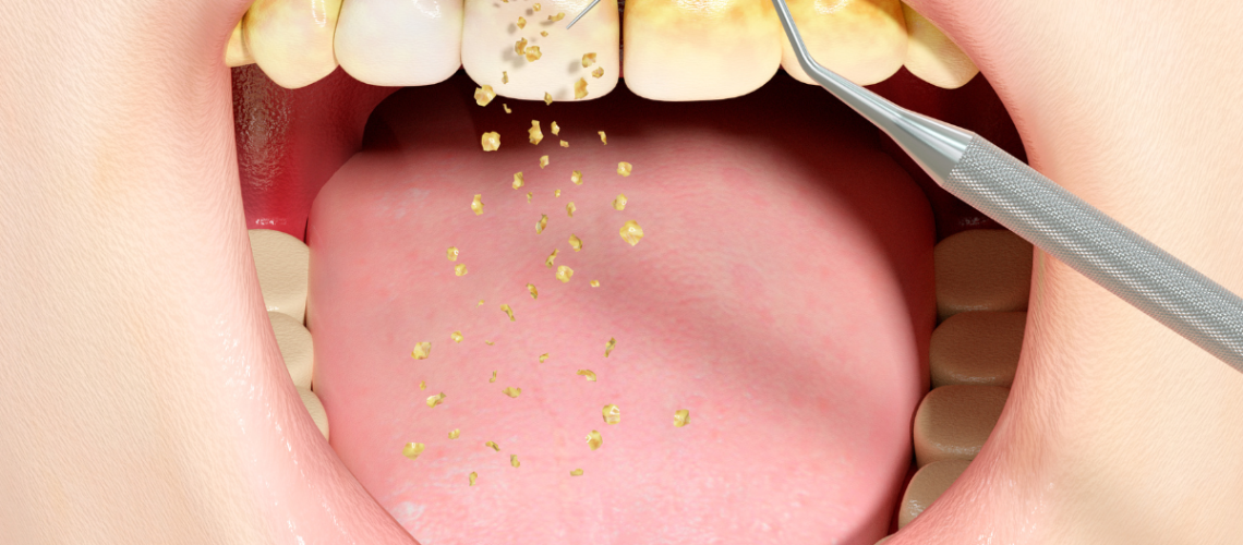 limpeza dentária em blumenau DR. ALEXANDREVOLTOLINI (1200 x 675 px)