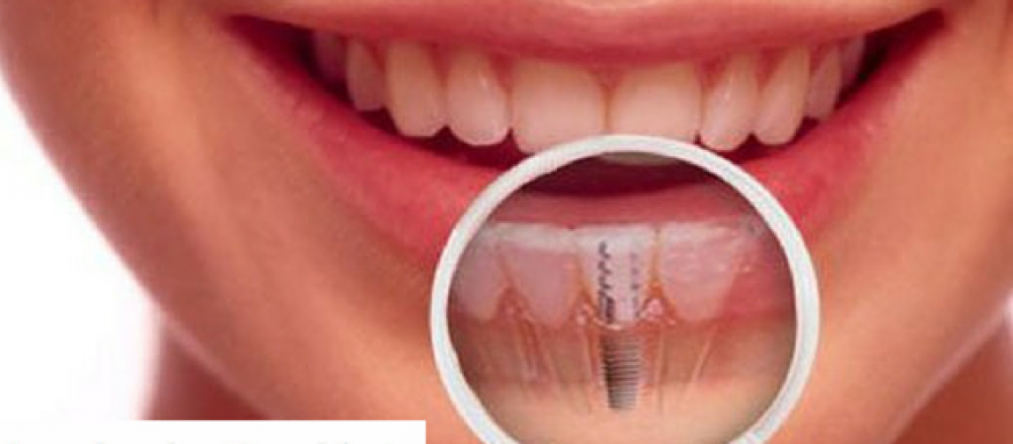 planejar o meu implante dentário em blumenau